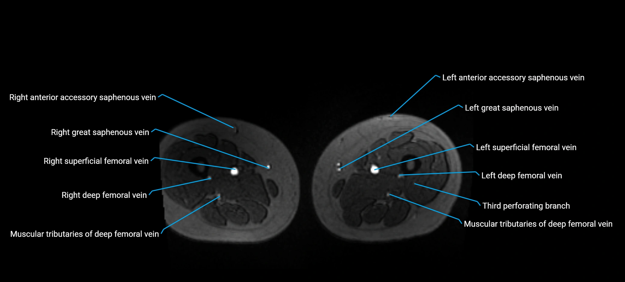 MRV abdomen pelvis & lower limb axial cross sectional anatomy labelled MRI image 275 (1).webp